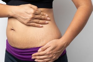 How to get rid of stretch marks?