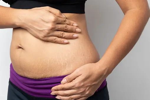 How to get rid of stretch marks? Top Secrets!