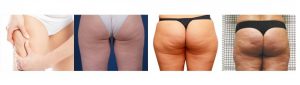 Everything about Cellulite.TOP Explanation