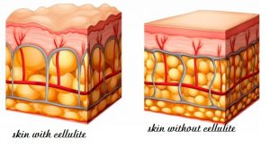Everything about Cellulite.TOP Clear Explanation