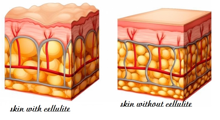 Everything about Cellulite.TOP 3 Clear Explanation what helps
