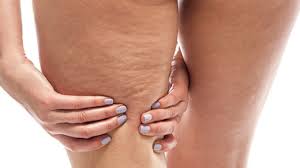 Sagging skin After Weight Loss